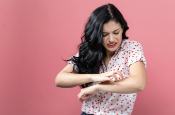 eczema